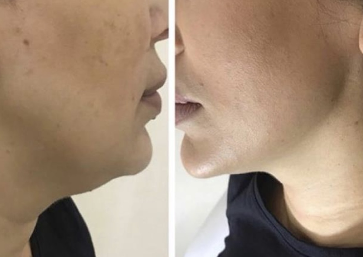 Avant après : redéfinition de l'ovale du visage et de la ligne mandibulaire