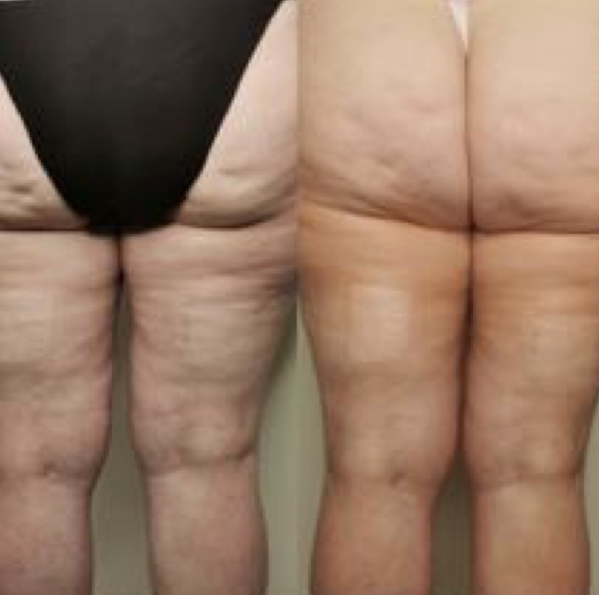 Avant après : traitement de l'aspect capitonné des cuisses et des fessiers