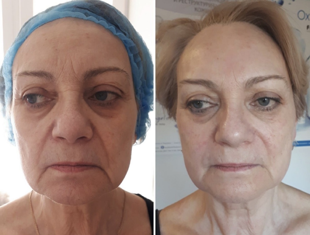 Avant après : atténuation des rides et raffermissement du visage