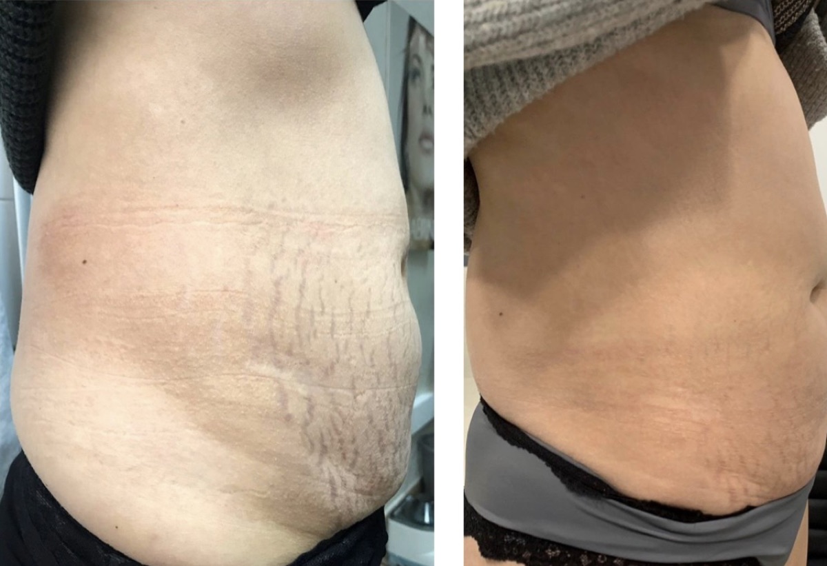 Avant après : lissage des vergetures abdominales