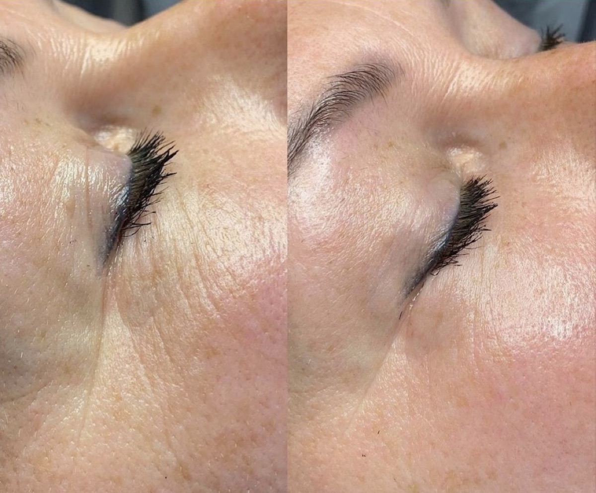 Avant après : lissage des ridules du contour de l'œil